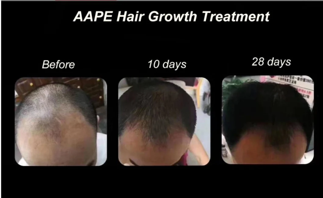 2023efficient Aape Anti Women′ and Men′ Hair Loss Hair Loss Care Repairing Hair Growth Hair Regrowth Stem Cell Treatment Hair-Loss Prevention Skin Anti-Wrinkle