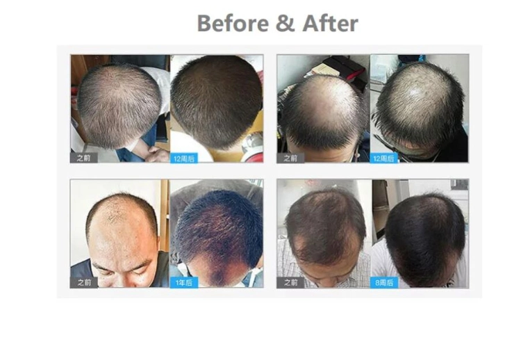 Hair PRO Laser Hair Growth Cap Men and Women